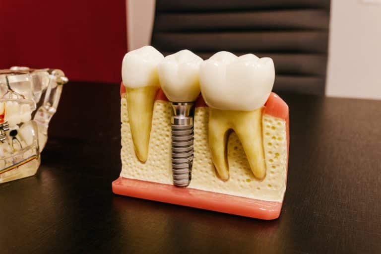 Implant dentaire offrant un sourire naturel et fonctionnel