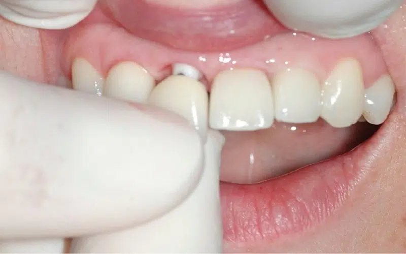 Quels sont les risques d'un implant dentaire